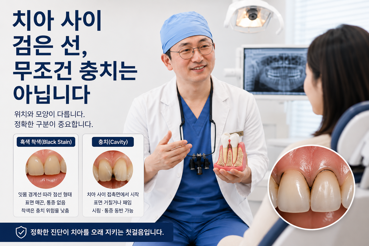 치아 사이 검은 선, 무조건 충치는 아닙니다